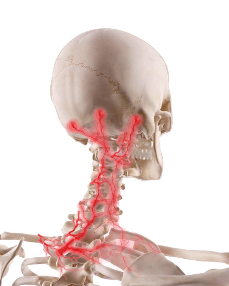 Cervicogenic Headaches Underlying Triggers Sciatica Clinic