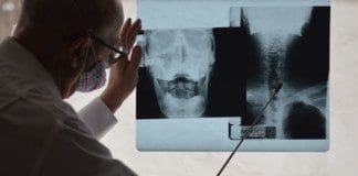 Syringomyelia Spinal Cord Disorder