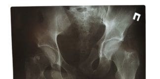 Sacral Fracture