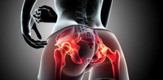 Piriformis Syndrome May Cause More Than Hip Pain
