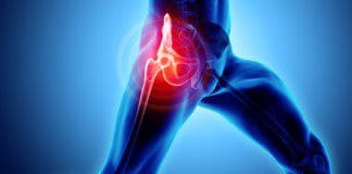 The Impact On Osteoarthritis On The Hips