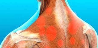 Myofascial Trigger Pain Affecting The Trapezius Muscle