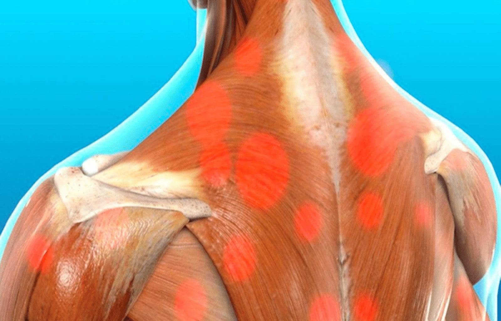 Muscle Knots - Trigger Points: El Paso Back Clinic