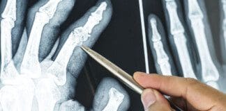Treating Finger Sprains and Dislocations: An Analysis