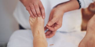 Healing Plantar Fasciitis with Acupuncture: A Guide for Patients