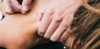 Solve Myofascial Pain Syndrome with Acupuncture