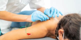 Improve Athletic Performance with Acupuncture: The Natural Way