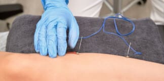 Is Acupuncture Painful? Debunking the Myths and Misconceptions