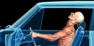 Whiplash and Achilles Tendinosis: Auto Accidents Explained